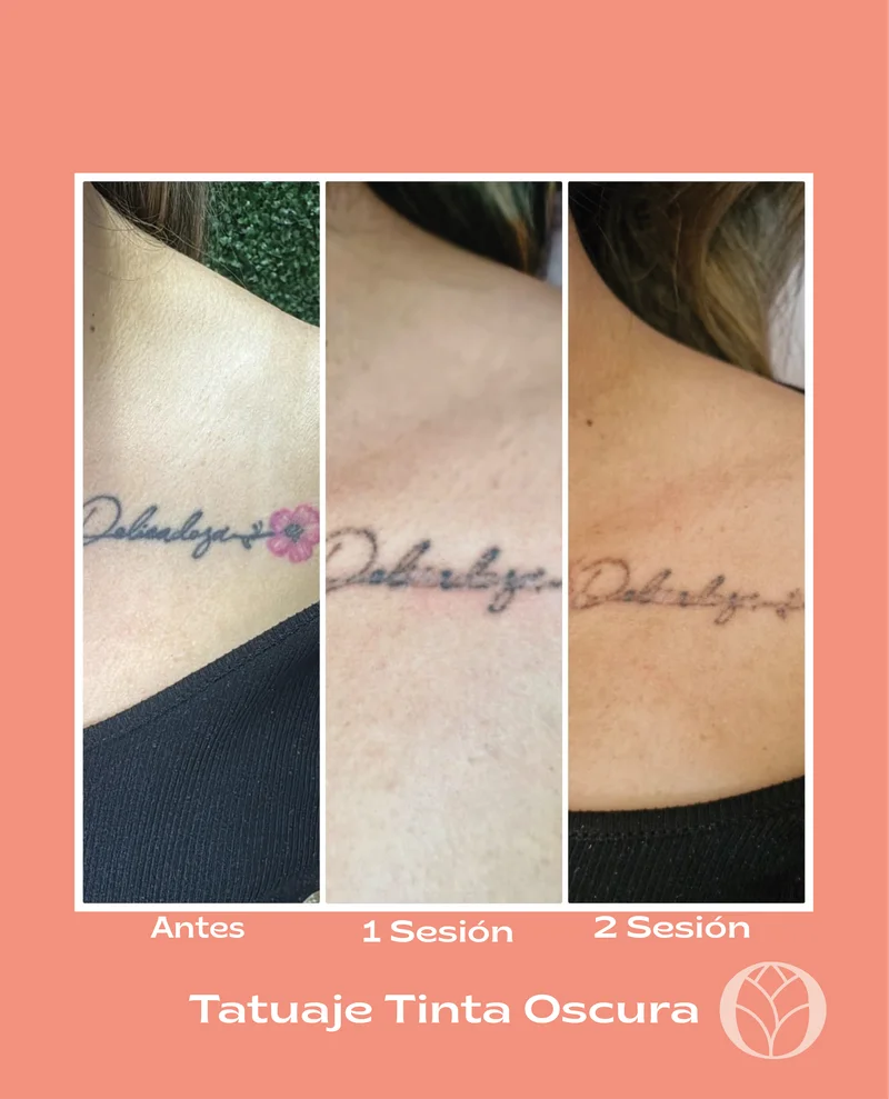 Progreso en eliminación de tatuajes con láser