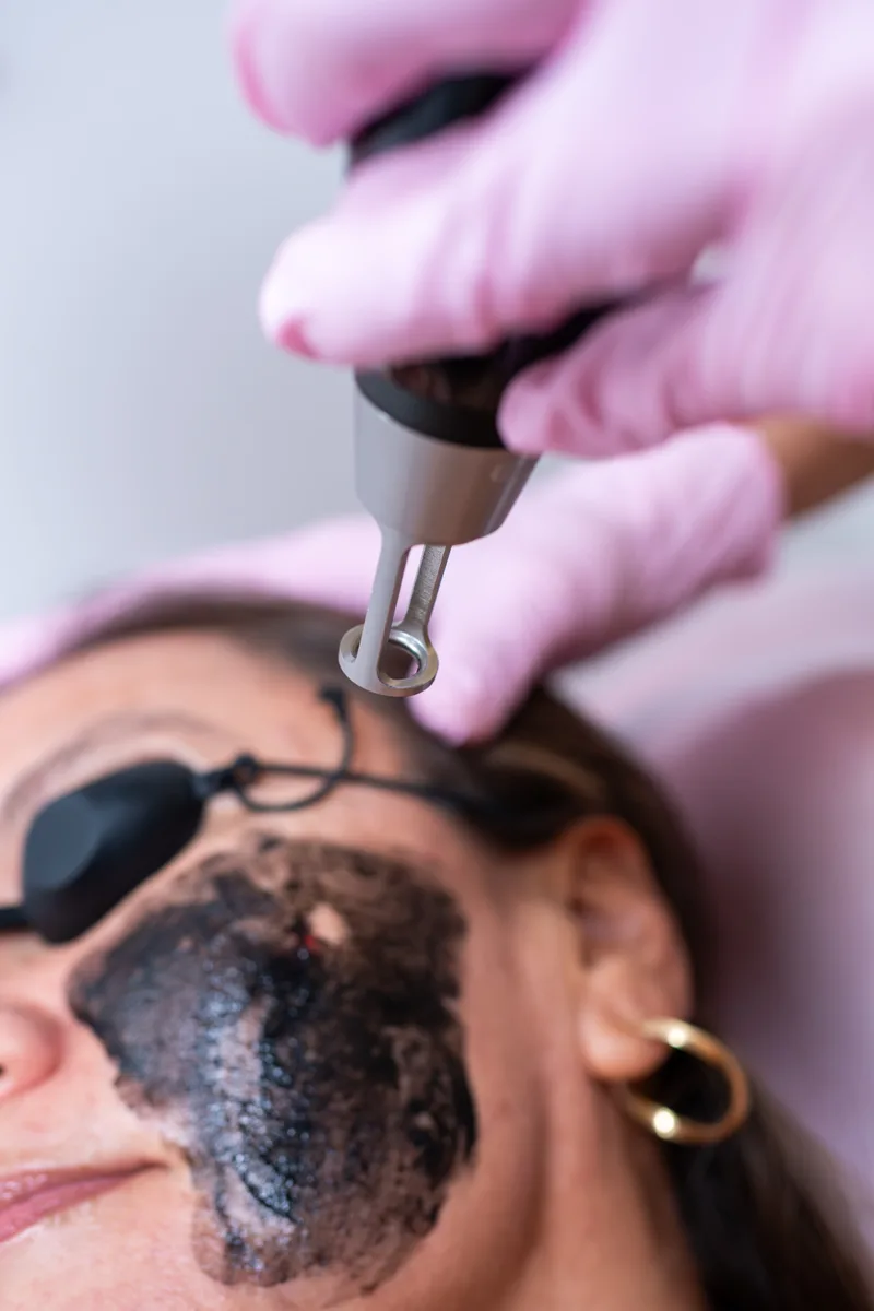 Tratamiento facial Hollywood Peel en cabina