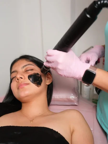 Procedimiento de Hollywood Peel con carbón activo y láser