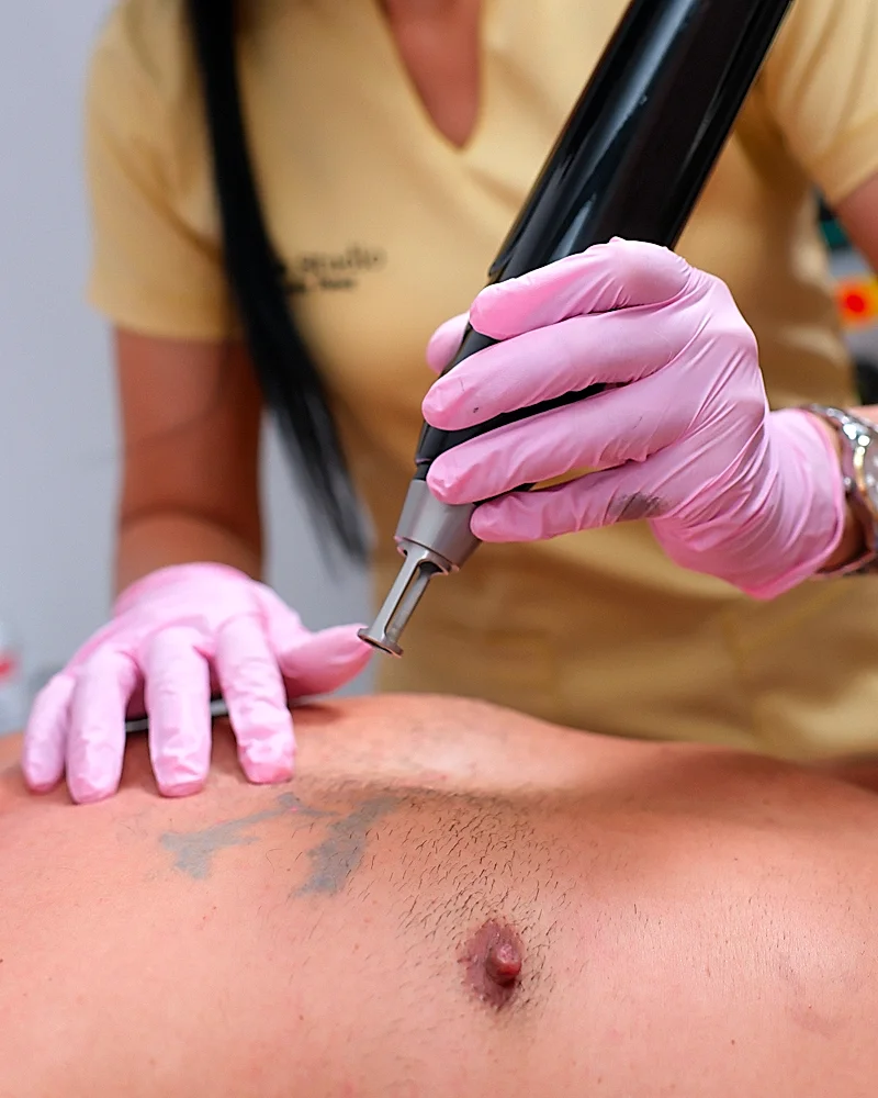 Paciente en proceso de borrado de tatuaje con tecnología láser